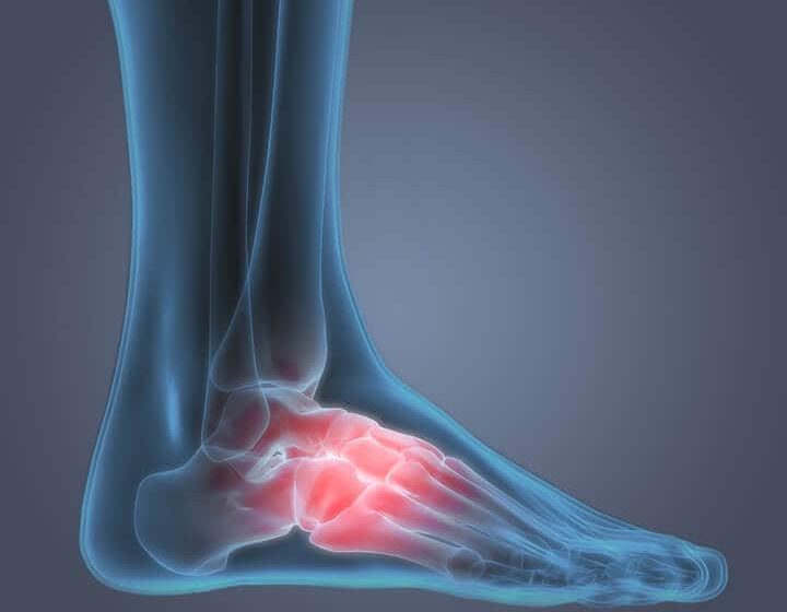  Pain in Arch of Foot | 4 Likely Causes You Should Know