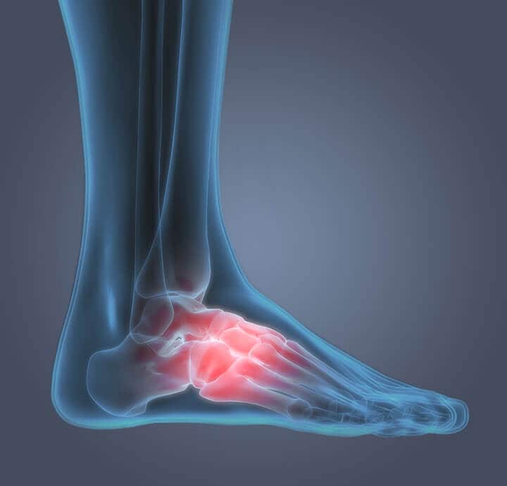 Pain in Arch of Foot | 4 Likely Causes You Should Know