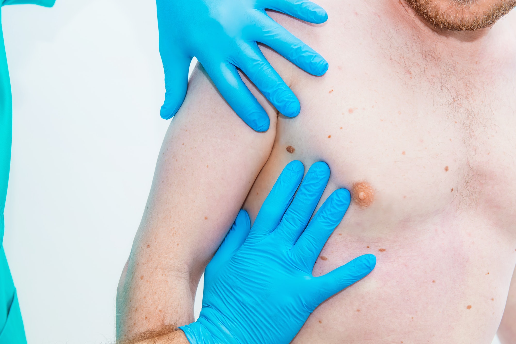 Doctor dermatologist hands in gloves examine underarm birthmark of male patient in clinic.