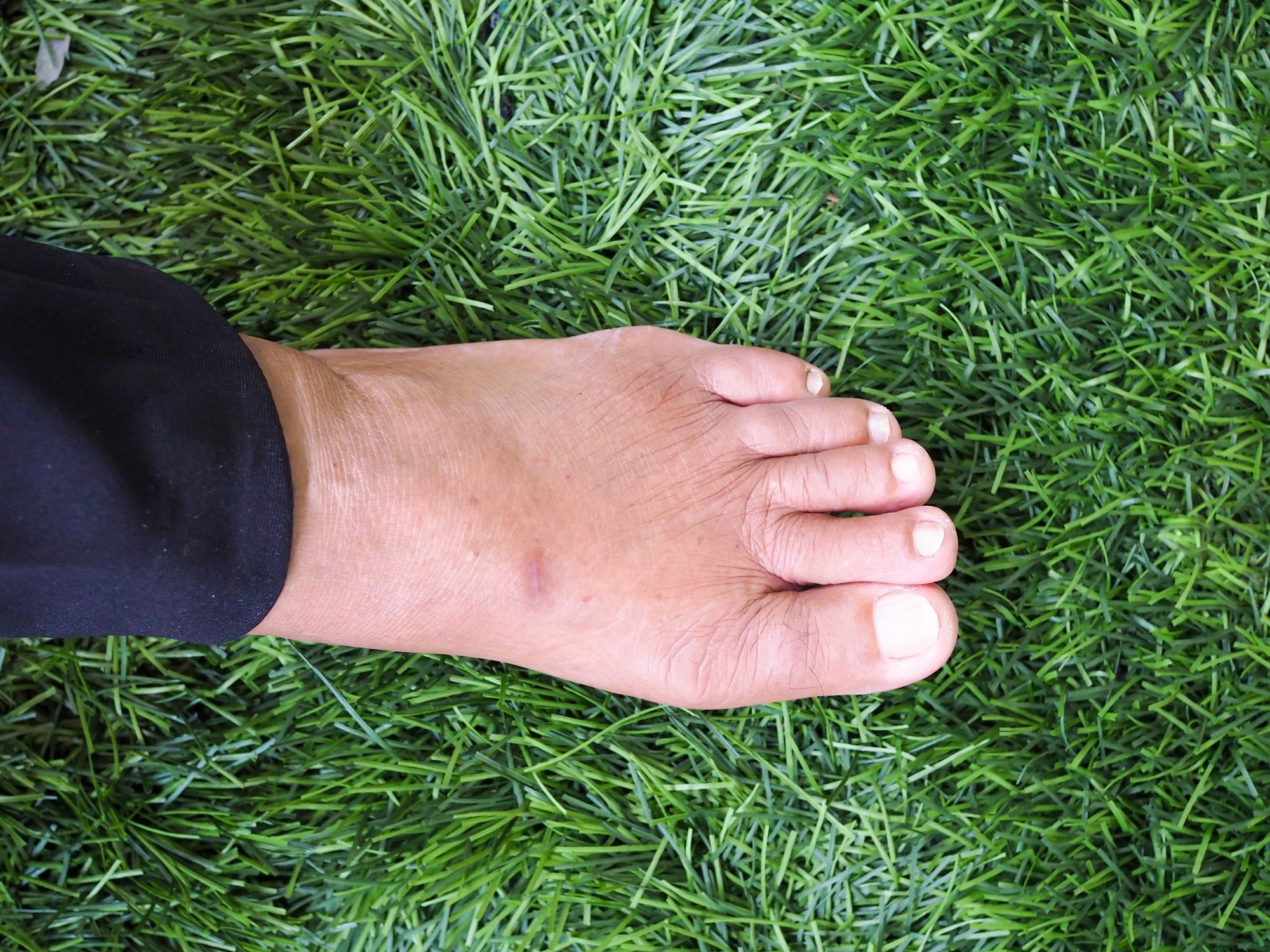 Do Your Feet Swell With Kidney Disease