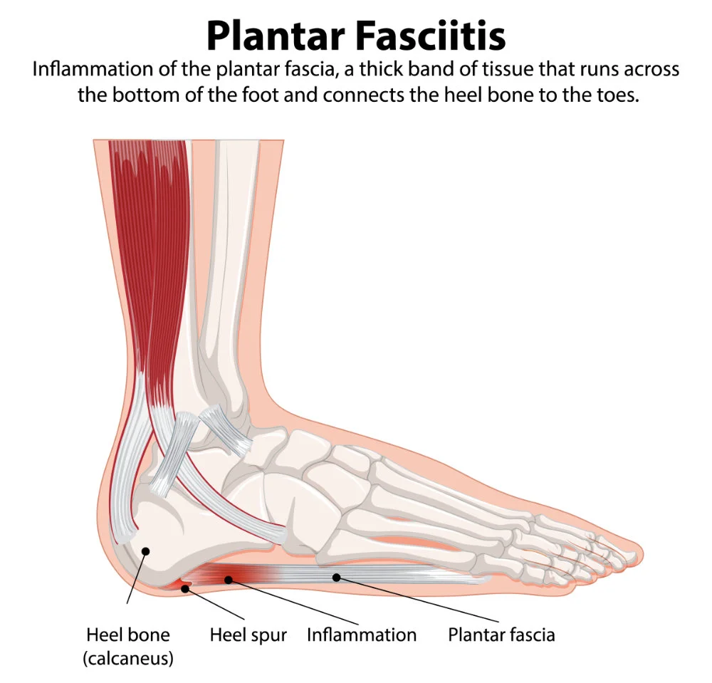 Plantar Fasciitis Plantar Fasciitis